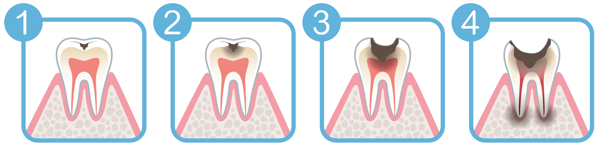 虫歯の進行
